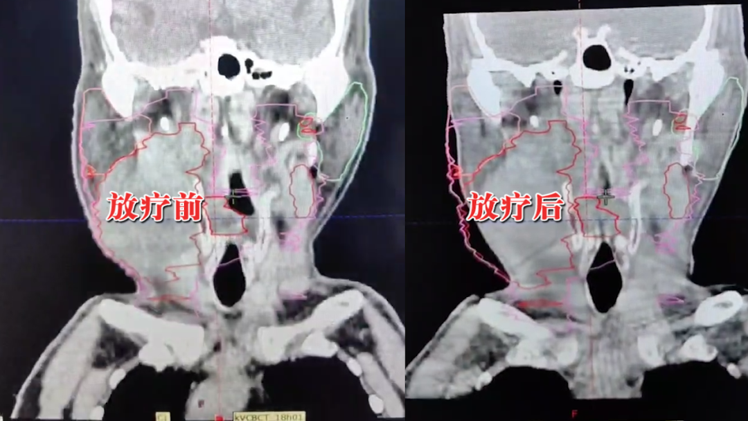 病例分享|个性化精准方案缩瘤，患者连送锦旗致谢